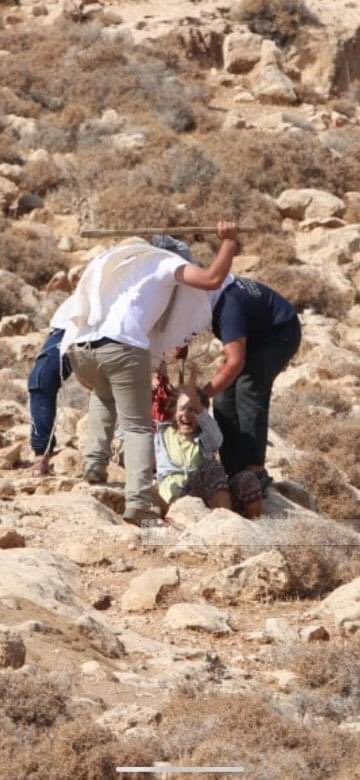 Breaking| Israeli settlers brutally stabbed and beat a foreign female activist while she was helping Palestinian farmers in picking olives in Kisan village, east of Bethlehem.