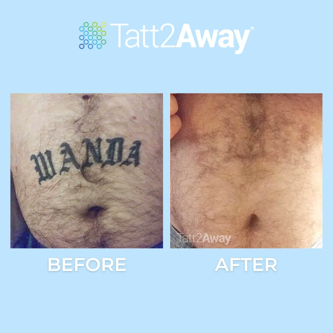 Tatt2Away's tweet photo. What's in a name (tattoo), if that name doesn't have to stay forever? Book your free consultation at the link in our bio and start removing your unwanted tattoo today! https://t.co/yzvTiUL12n  
#tattooremoval #nonlasertattooremoval #organictattooremoval #tattooartist https://t.co/Hb2l3PTIdd