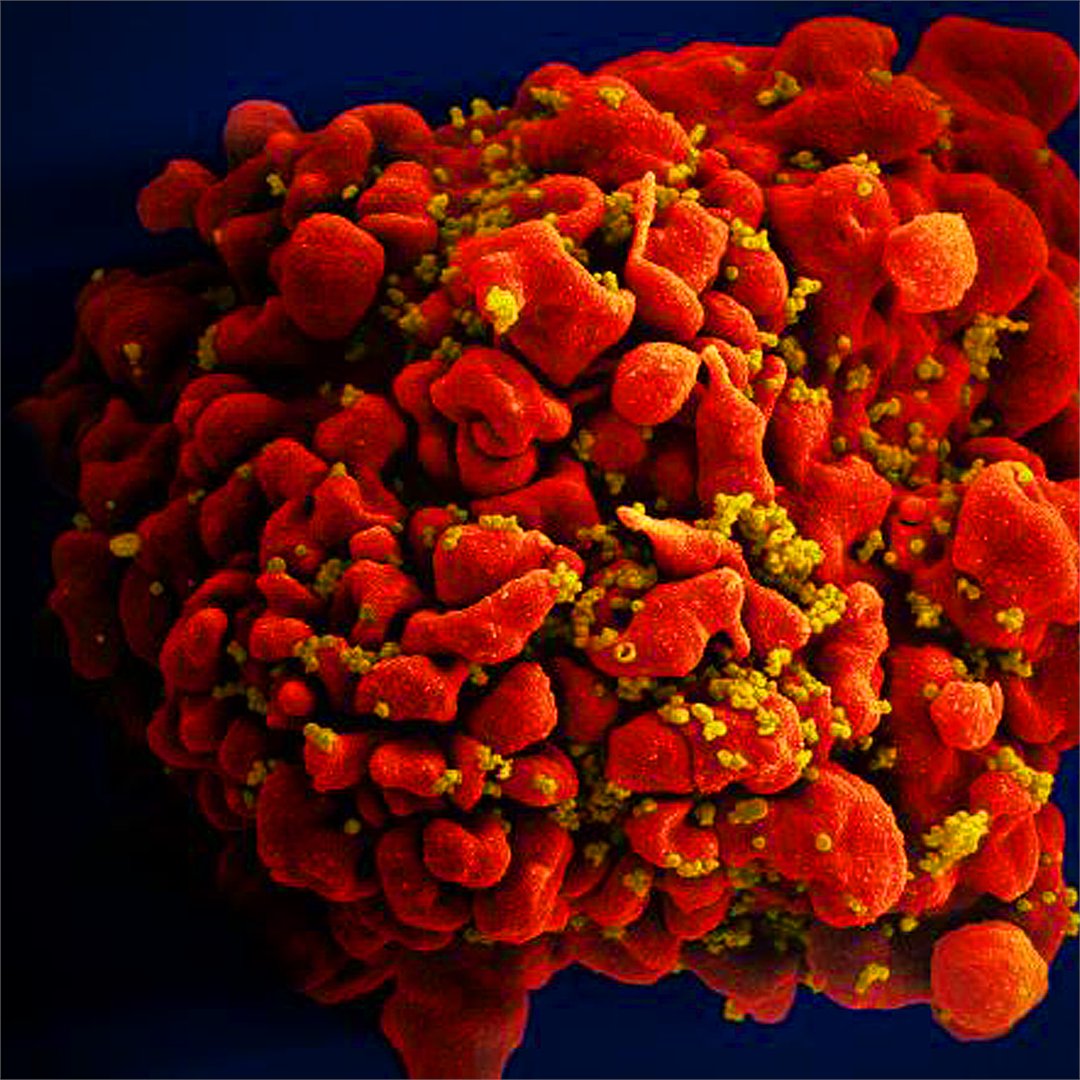 Now we can track the progress of HIV infections more accurately than before. This new method may make it possible to target the molecules that enable the virus to grow. #HIV #AIDS kth.se/en/om/nyheter/…