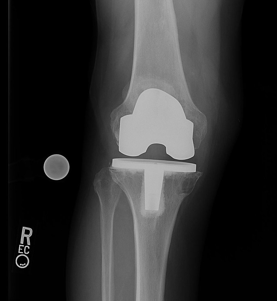 HSS_ARJR_CJRC's tweet photo. Complexity is our specialty at the #snfcjrc.
Pain, instability, wear, and osteolysis: CCK vs. Hinge
Tune in today at 2pm EST to see how we treated this recalled implant
#Medtwitter #HSS #revisionsurgery #complexjoint #orthotwitter #carp
@HSpecialSurgery @HSSProfEd https://t.co/X0HgZHcpuQ