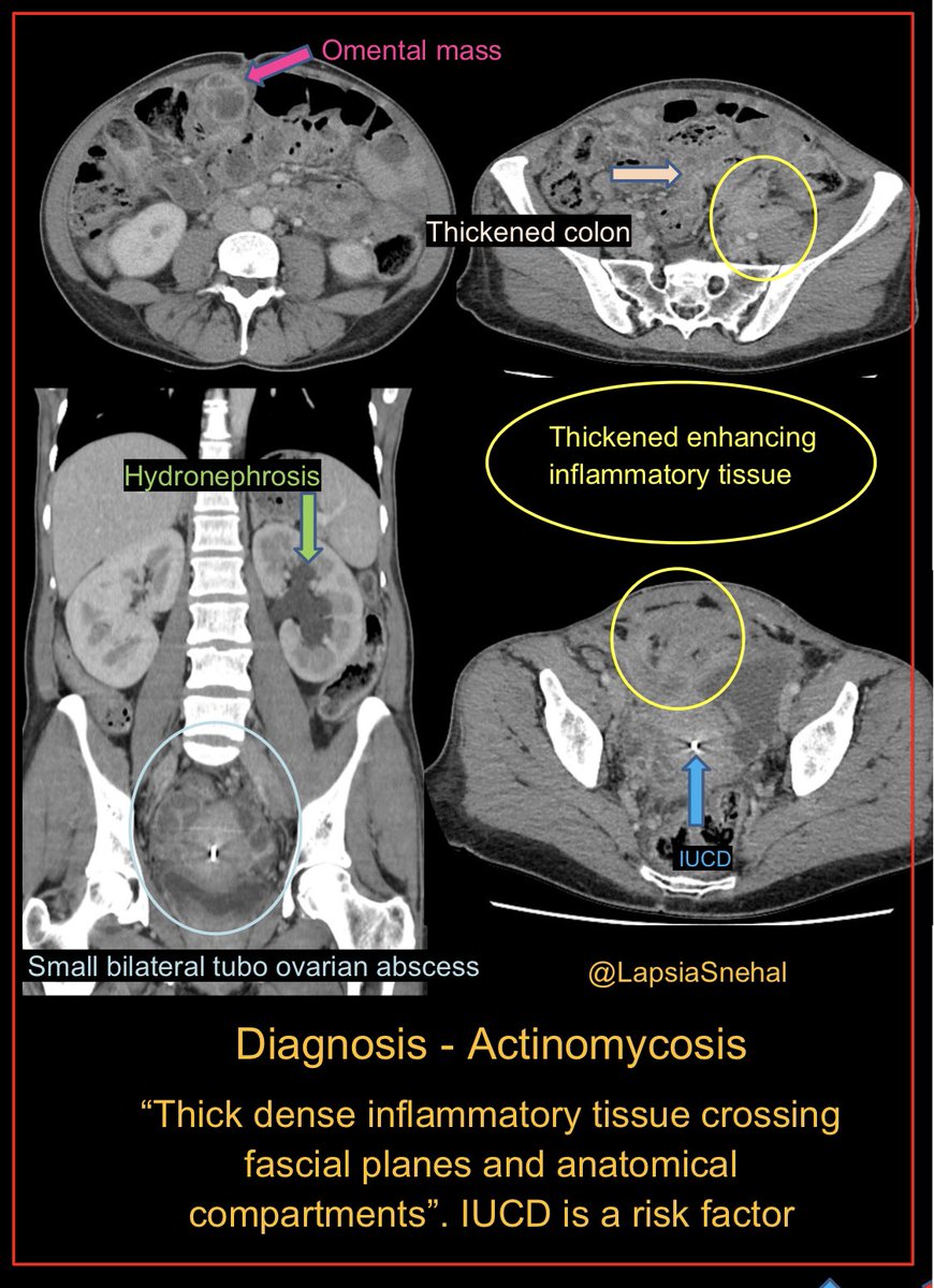 LapsiaSnehal's tweet photo. Diseases that affect multiple compartments are often the hardest to diagnose. #FOAMrad #FOAMed #meded  #radres #futureradres #medstudenttwitter #gitwitter #anatomy #frcr #surgery #radiology #radtwitter #medtwitter #obgyntwitter #obygyn #urorad https://t.co/rDsoXIbi4b