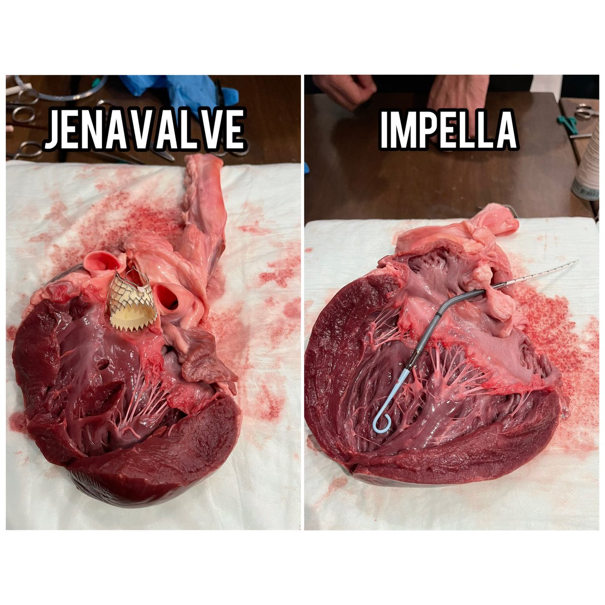 arianaehsanmd's tweet photo. What we got into! Youβll see a #Watchman, #MitraClip, #JenaValve, #Impella, and two #pacemakers - w/ and w/o leads. Thank you @DrTomWaggoner for your efforts in making our annual heart dissection a tradition for our teams! #SHD #ClinicalResearch #TMCHealth #HeartDissection 2/2 https://t.co/gOOpZ9gMQz