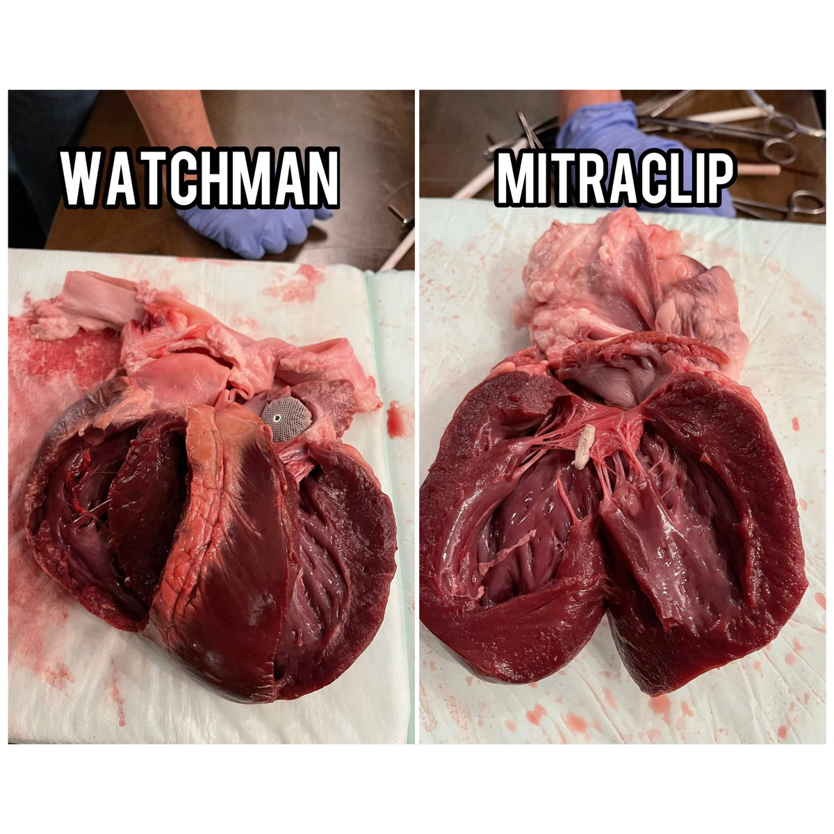 arianaehsanmd's tweet photo. What we got into! Youβll see a #Watchman, #MitraClip, #JenaValve, #Impella, and two #pacemakers - w/ and w/o leads. Thank you @DrTomWaggoner for your efforts in making our annual heart dissection a tradition for our teams! #SHD #ClinicalResearch #TMCHealth #HeartDissection 2/2 https://t.co/gOOpZ9gMQz