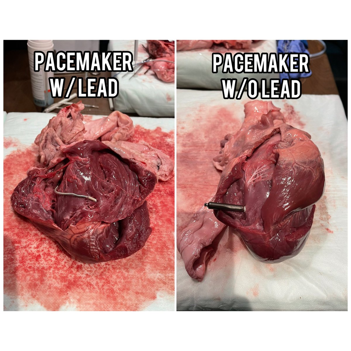 arianaehsanmd's tweet photo. What we got into! Youβll see a #Watchman, #MitraClip, #JenaValve, #Impella, and two #pacemakers - w/ and w/o leads. Thank you @DrTomWaggoner for your efforts in making our annual heart dissection a tradition for our teams! #SHD #ClinicalResearch #TMCHealth #HeartDissection 2/2 https://t.co/gOOpZ9gMQz