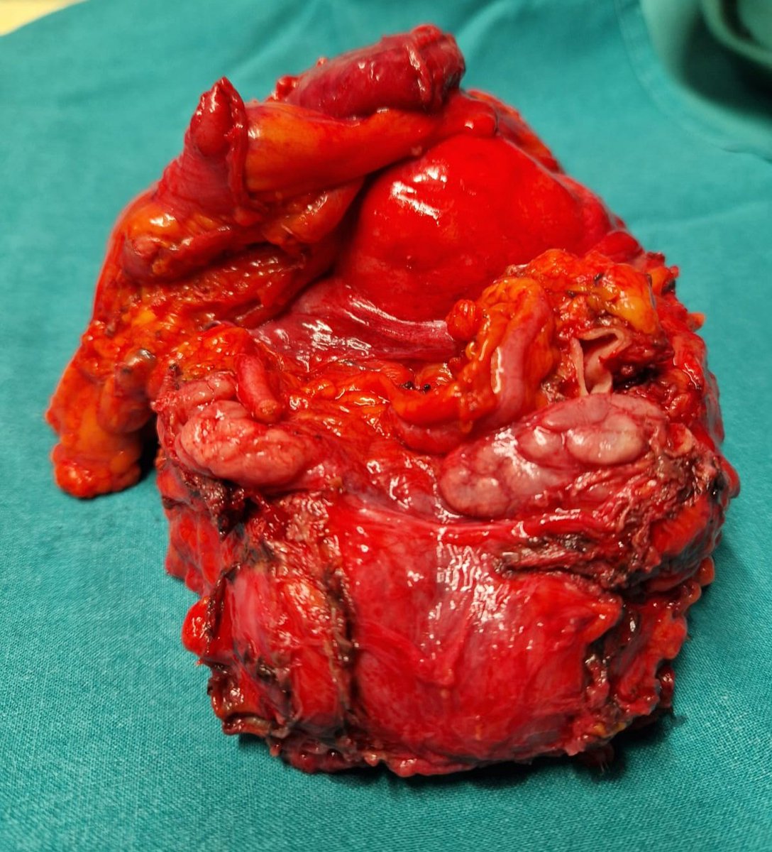 Flavia Proietti (@flavia_proietti) on Twitter photo Radical cystectomy for bladder cancer with ileum and sigma involment + Adrenal metastasectomy.
One surgery, thousand techniques 📝
<a href="/SapienzaUrology/">Sapienza Urology</a> <a href="/uroCosta/">Costantino Leonardo</a> <a href="/uroLeslieLicari/">Leslie Claire Licari</a> <a href="/Eugenio_Bologna/">Eugenio Bologna</a> Radical cystectomy for bladder cancer with ileum and sigma involment + Adrenal metastasectomy.
One surgery, thousand techniques 📝
<a href="/SapienzaUrology/">Sapienza Urology</a> <a href="/uroCosta/">Costantino Leonardo</a> <a href="/uroLeslieLicari/">Leslie Claire Licari</a> <a href="/Eugenio_Bologna/">Eugenio Bologna</a>