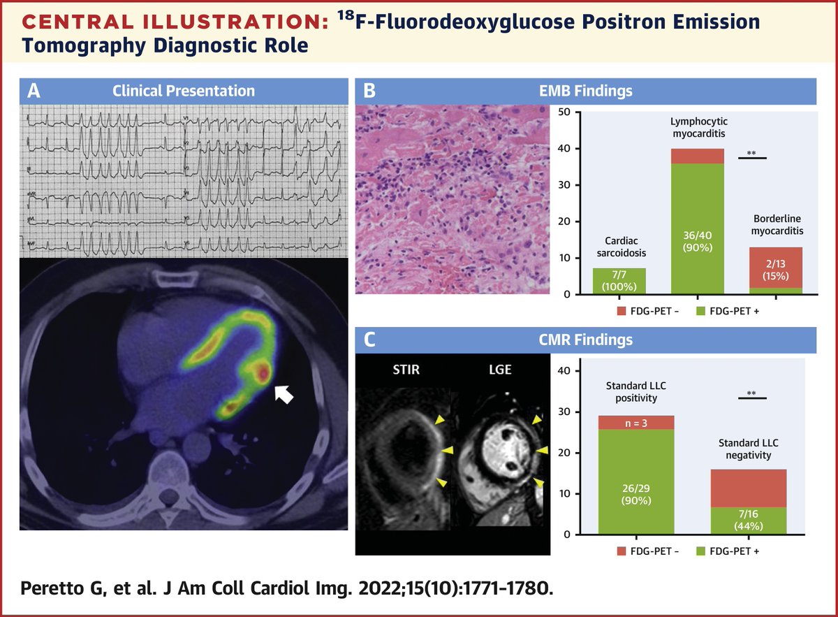 JACCJournals's tweet photo. FDG-PET: new application in #myocarditis? This #JACCIMG study provides novel insights about the use of FDG-PET scan as a meaningful tool to guide diagnosis, risk stratification and treatment in patients with biopsy-proven arrhythmic myocarditis. https://t.co/x5tsKsQa3y #cvNuc https://t.co/X2IU5JIpnS