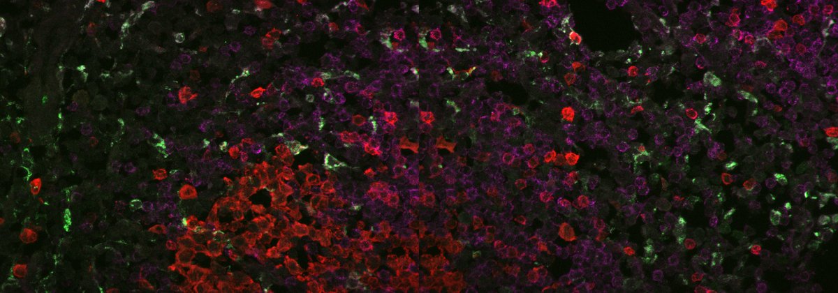 Dinis Calado (@diniscalado) on Twitter photo Hello! Open PhD position tinyurl.com/2b5dfrmb to study "Immune cell interactions in germinal centers driven by triple negative breast cancer"- What?!!!
With the KCL Cancer Bioinformatics Group <a href="/KCLCancerBioGrp/">KCL Cancer Bioinformatics Group</a>
Apply here tinyurl.com/3jz4ks2z by 12:00 noon (GMT), 10 Nov 22 Hello! Open PhD position tinyurl.com/2b5dfrmb to study "Immune cell interactions in germinal centers driven by triple negative breast cancer"- What?!!!
With the KCL Cancer Bioinformatics Group <a href="/KCLCancerBioGrp/">KCL Cancer Bioinformatics Group</a>
Apply here tinyurl.com/3jz4ks2z by 12:00 noon (GMT), 10 Nov 22