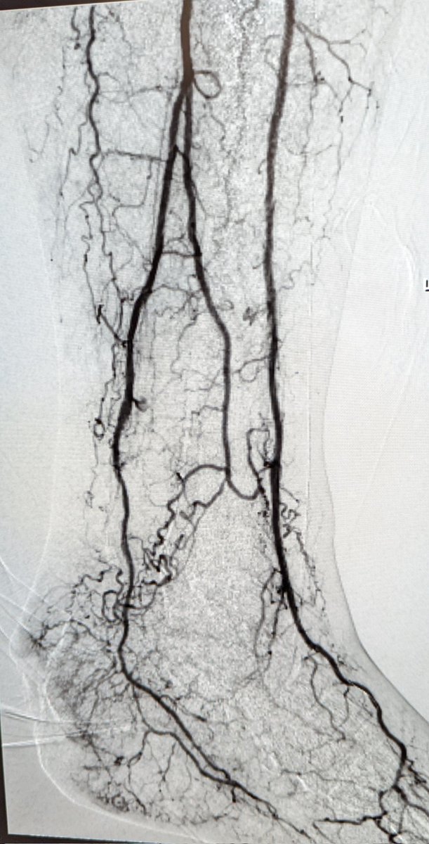 Mark Lessne, MD (@lessnevir) on Twitter photo Large heal ulcer. Outside failure.
I do AT & PT recan trans pedal loop- gr8 result, right?
But pt admitted OSH again- no wound care & surgical care only offers BKA. Trying to get pt to my team ASAP.
#CLIFighter is a team sport!
#IRad <a href="/SIRspecialists/">Society of Interventional Radiology</a> <a href="/VascularSVS/">Vascular SVS</a> Large heal ulcer. Outside failure.
I do AT & PT recan trans pedal loop- gr8 result, right?
But pt admitted OSH again- no wound care & surgical care only offers BKA. Trying to get pt to my team ASAP.
#CLIFighter is a team sport!
#IRad <a href="/SIRspecialists/">Society of Interventional Radiology</a> <a href="/VascularSVS/">Vascular SVS</a>