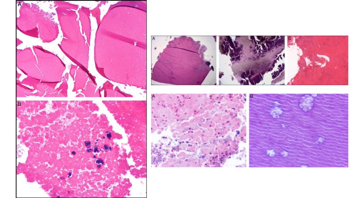 Researchers have identified and characterized an apparently distinct form of bacterial sinusitis which they term bacteroma or bacteria-related concretion. It overlaps clinically with mycetoma and AFS and can occasionally be seen with mycetoma. @mitra_mehrad