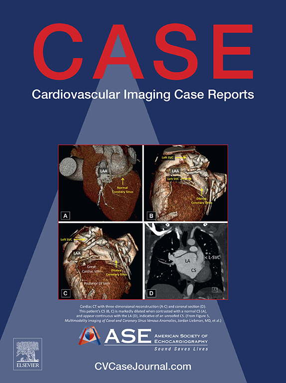 READ @CASEfromASE: cvcasejournal.com/current EIC @VLSorrellImages says, “This issue includes a CASE series demonstrating the normal & pathologic variations of caval & coronary sinus venous anomalies. This is an important report that includes outstanding 3D-CCT image correlations.”