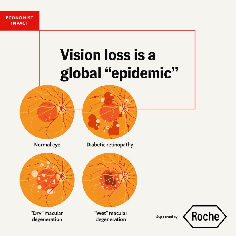 econ_enterprise's tweet photo. In developed countries, retinal diseases, including age-related macular degeneration and diabetic retinopathy, are the most common cause of irreversible blindness presenting a growing public health issue. Learn more from our infographic