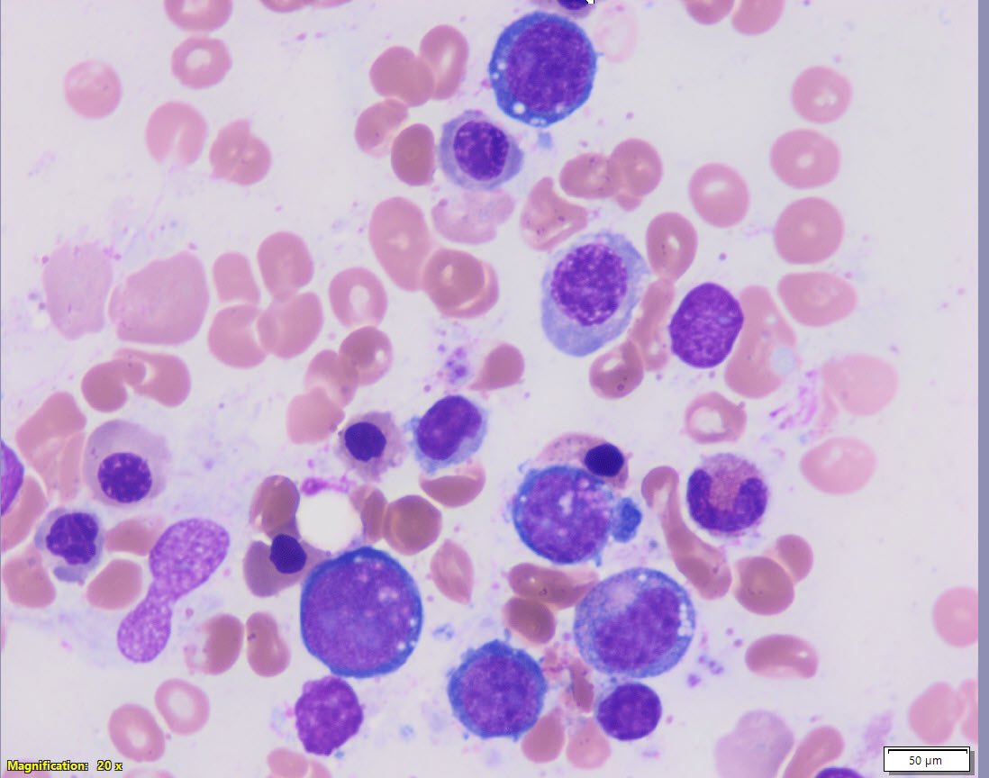 sanamloghavi's tweet photo. Takes 100 mg of #Zinc 3 times a day 😒 
#hemepath PSA: STOP self-prescribing excessive zinc people, it depletes your #copper and makes your bone marrow very angry 😡 https://t.co/vbkBUA9dKH