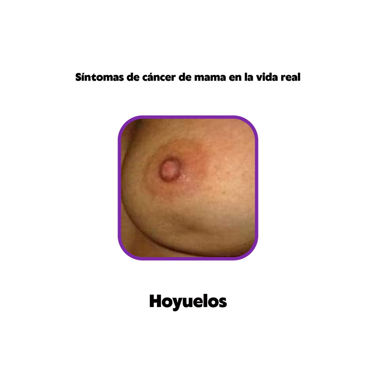caribenxs's tweet photo. Las imagénes e ilustraciones que vemos todos los años en el día contra el #cancerdemama no son claros sobre los síntomas, ¿cómo se ven en la vida real? Aquí te dejamos algunas fotos compartidas por la Sociedad Estudiantil de Medicina (sem) https://t.co/UkvVJDFGXm