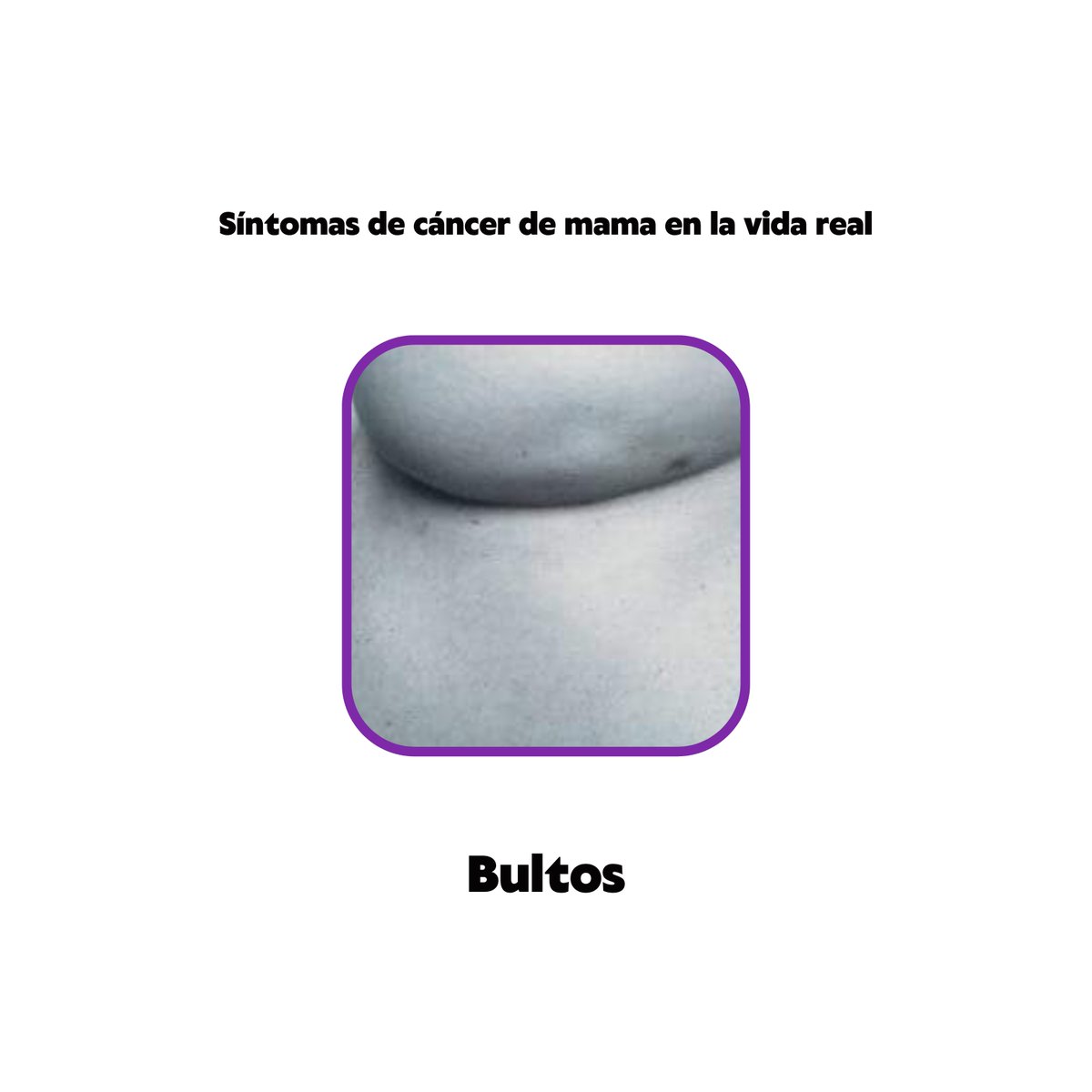caribenxs's tweet photo. Las imagénes e ilustraciones que vemos todos los años en el día contra el #cancerdemama no son claros sobre los síntomas, ¿cómo se ven en la vida real? Aquí te dejamos algunas fotos compartidas por la Sociedad Estudiantil de Medicina (sem) https://t.co/UkvVJDFGXm