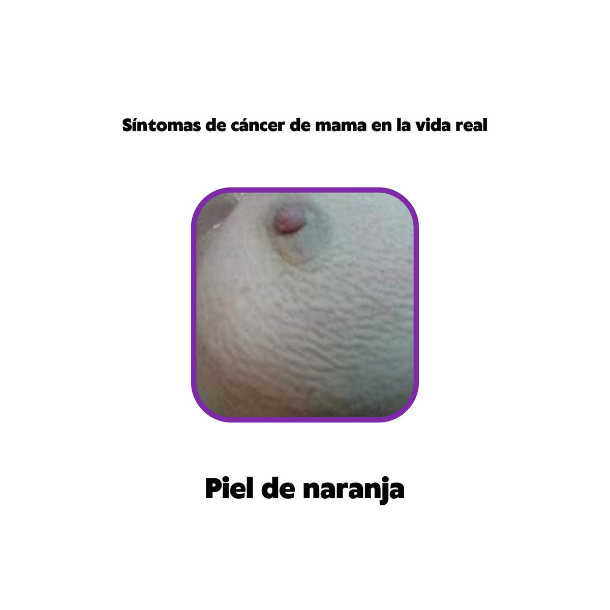 caribenxs's tweet photo. Las imagénes e ilustraciones que vemos todos los años en el día contra el #cancerdemama no son claros sobre los síntomas, ¿cómo se ven en la vida real? Aquí te dejamos algunas fotos compartidas por la Sociedad Estudiantil de Medicina (sem) https://t.co/UkvVJDFGXm