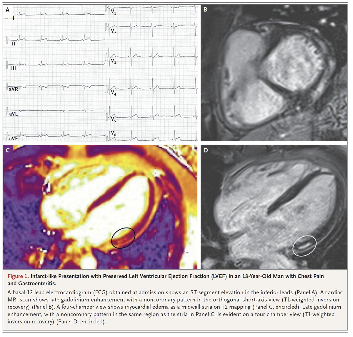 A timely, outstanding @NEJM review on myocarditis today nejm.org/doi/full/10.10… by @Cristinabasso64