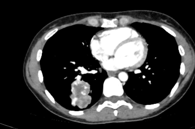 draceciferrario's tweet photo. 41-year-old female patient with abdominal pain and rising β-hCG.
No pregnancy is detected on US. Exploratory laparoscopy is performed to rule out ectopic pregnancy. Nothing was found on the procedure but we found this on the CT... https://t.co/n7HI3Ha5lk