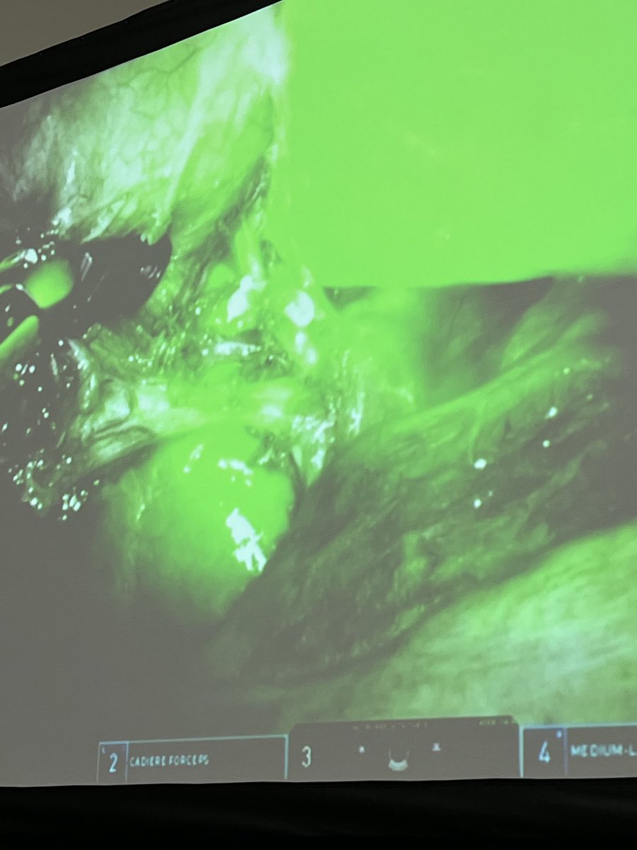 JsharmaSharma's tweet image. ⁦@EmorySurgery⁩ resident Jessica Labib presents on value of routine ICG in cholecystectomy, mentor ⁦@FedeSerrotMD⁩ ⁦@AnkitPatelMD⁩, ⁦@AmCollSurgeons⁩ #acscc22 GREAT JoB