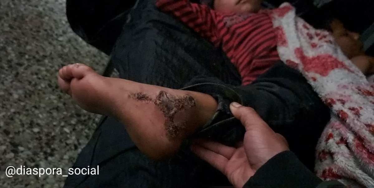 diaspora_social's tweet photo. Este es el pie de un niño de 5 años quien fue agredido con un gas lacrimogeno por un agente del ESMAD en las manifestaciones del 19 de octubre en la ciudad de Bogota. No recibió atención médica. @ClaudiaLopez por él no se preocupa? https://t.co/fwycVrjxvk