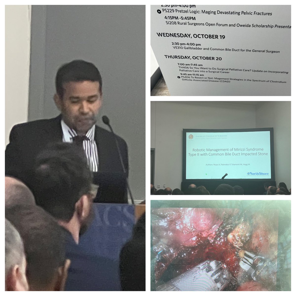 @aramrojas presentating robotic @IntuitiveSurg management of Type II Mirizzi Symdrome for a packed audience #ACS2022