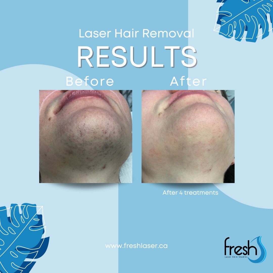 fresh_laser's tweet photo. Looking for #laserhairremoval in #YYC? Check out our great #results for #facialhairremoval after just 4 treatments! Book a consultation with us for more information https://t.co/c995xvqRbX https://t.co/0Y7WEyGbc0