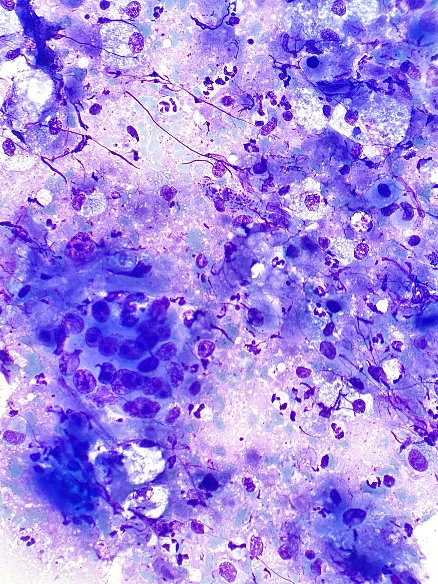 Gloria_SuraMD's tweet photo. Fine needle aspiration of a neck lymph node revealing what type of metastatic tumor? Answer: https://t.co/YYzUTA9uXl #PathArt #CytoPath #PathTwitter #Cytology https://t.co/U53f9csn3v