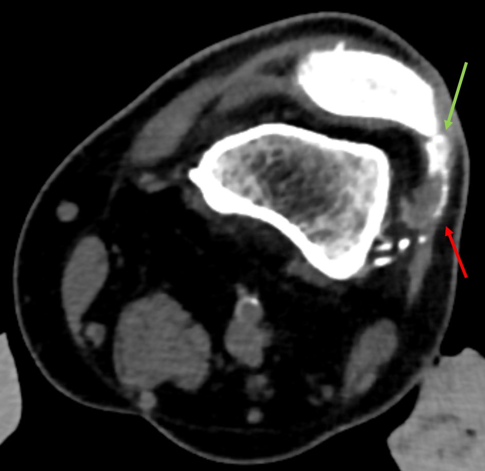 Power of intra procedure cross sectional imaging for GAE: Arterial branch marked with red arrow looks like non target vessel - multiplanar CT confirms supply to a pathologic osteophyte! #irad #msktwitter