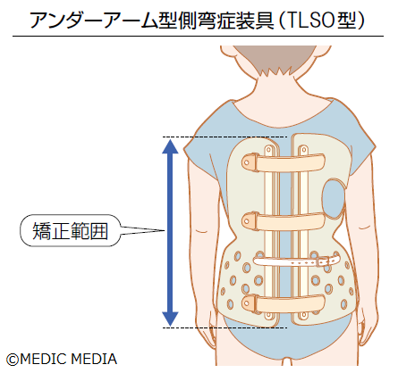 特発性側弯症】特発性側弯症の治療はCobb角が25°より小さければ約3ヵ月