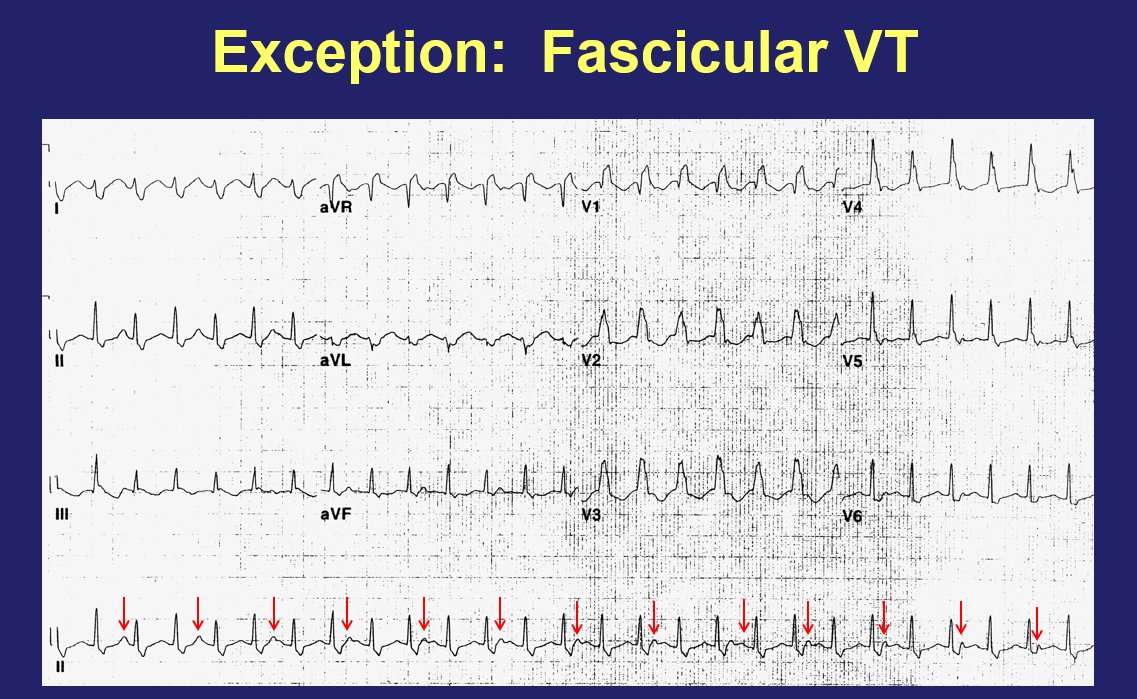 Fun presentation this weekend, to think about wide complex QRS/tachycardia, including contemplating various exceptions that may confound the various VT vs SVT/aberrancy algorithms! A few of my slides here and next tweet (I love talking about exceptions to rules!!) 1/2