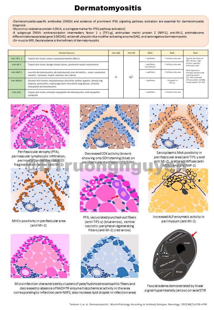 DTruongnguyen's tweet photo. #1:
Some notes about #Dermatomyositis
#musclebiopsy #neuromusclediseases #pathology #learn #neuromuscle #neurology https://t.co/lVoBuGajSI