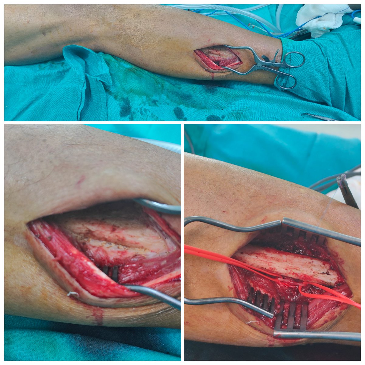 Peroneal artery lateral exposure without resecting the fibula for below knee bypass in a CLTI patient . @VarenyamVasc @tapishsahu @SavlaniaAjay @PShivanesandr @GAEscobarMD