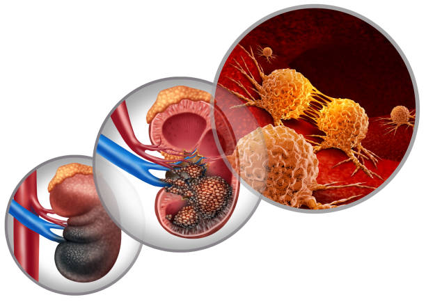 ijmrhs's tweet photo. #Kidney #cancer #disease #medical concept as #malignant #cells in a #human #body attacking the #urinary_system and #renal #carcinoma #anatomy as a symbol for #tumor #growth #treatment and #risk https://t.co/FjoW2a7Sy9