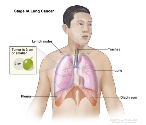 Join our PDQ cancer information session in @theNCI booth @UICC #WCC2022 10/20 at 10:40am to learn how to use this resource for health prof. & patients. The content is evidence-based, up-to-date, FREE, & available for syndication worldwide! Learn more bit.ly/3eEtELE