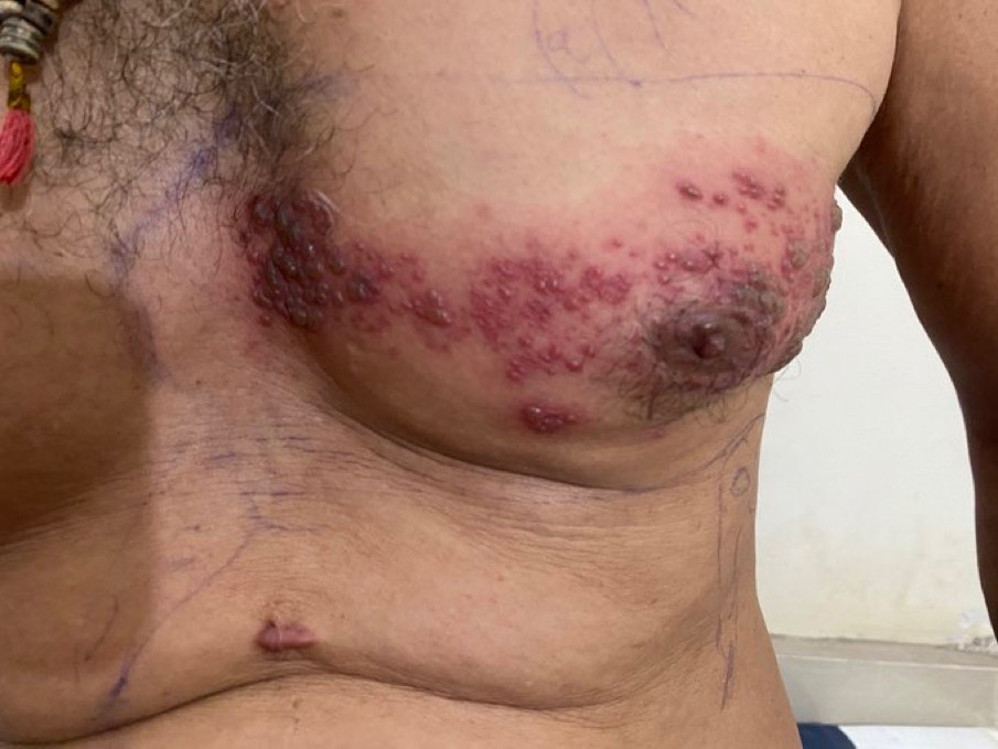 A 60 year old male presented with a localized, burning rash on his chest. What is the likely diagnosis & treatment? #Medtwitter