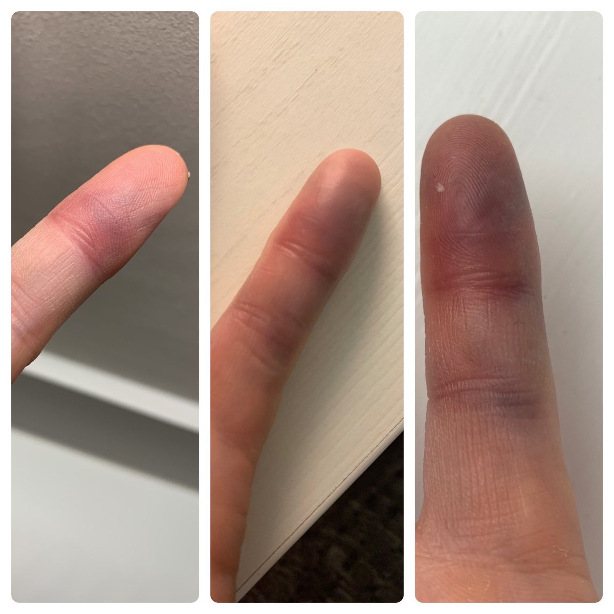 MelScotchford's tweet photo. Lunchtime basketball injury #primaryschool #hazzardofthejob 😂 https://t.co/Ez4omqAyg6