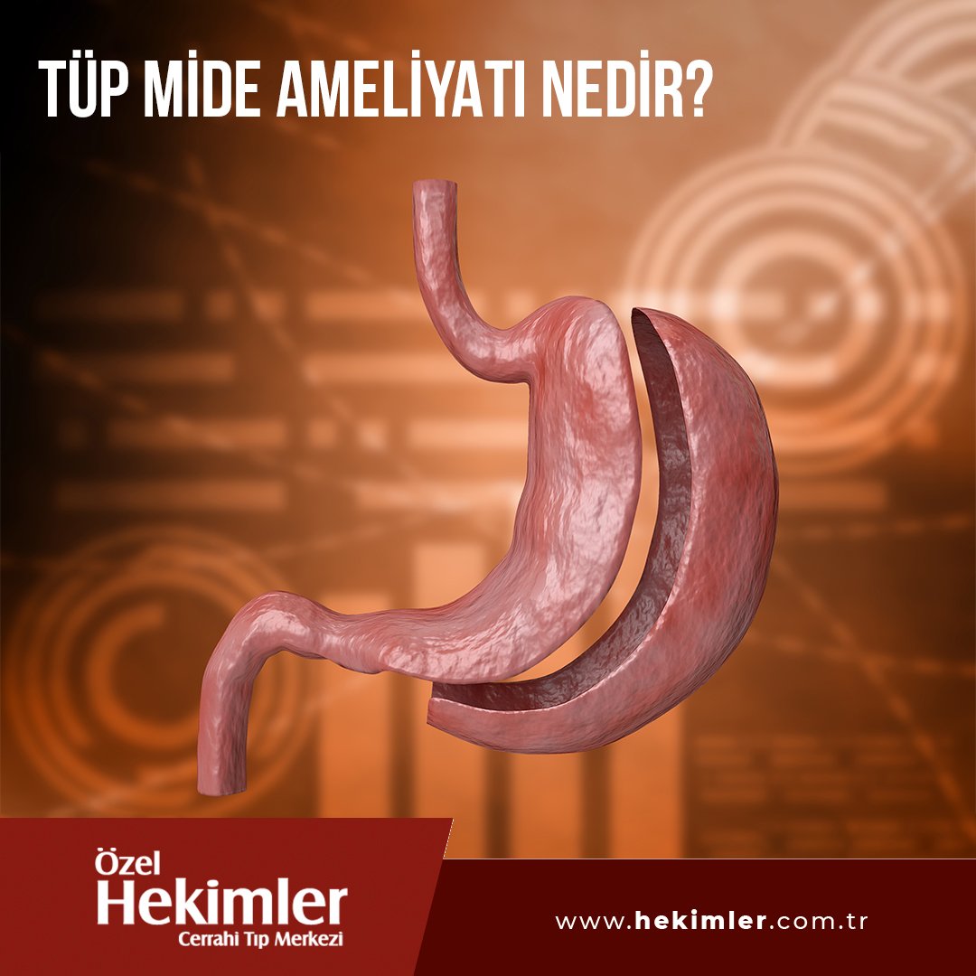 HekimlerTIP's tweet photo. Tüp Mide Ameliyatı;mide küçültme ameliyatı olarak bilinir.Estetik ve güzel görünmek amacıyla yapılmayan tüp mide ameliyatları;ileri derece obez olan kişilere,aşırı şişmanlığa bağlı hipertansiyon,uyku apnesi,tip 2 diyabet vb. rahatsızlıklar yaşayanlara uygulanır.  

#MideAmeliyatı https://t.co/9bOIYo4VGD