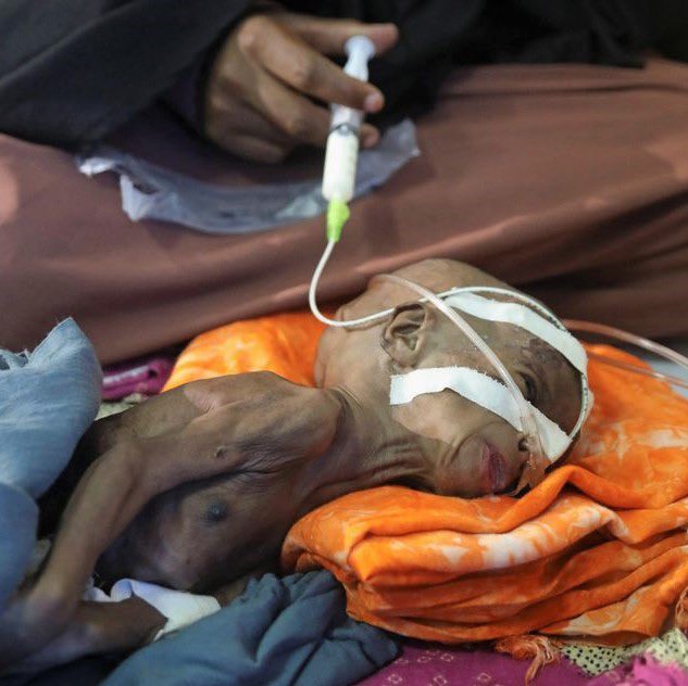 Yardım Çağrısı❗ Yemen'de açlık ve yetersiz beslenmeden dolayı masum çocukların ömrü kelebekler misali oldu 😔 200 mazlum Aile için mama yardımı başlatıyoruz. Bir mama bedeli 50₺ Lütfen elden ele paylaşıp destek olalım 🤲 Yardım için: DM Online bağış: mazlumlarinsesi.org.tr