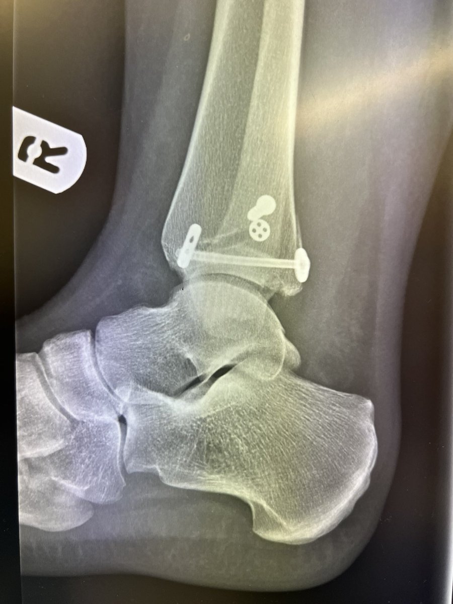 Two weeks post surgery, cast off, boot on for the next four weeks. Slow and steady wins the race🐢