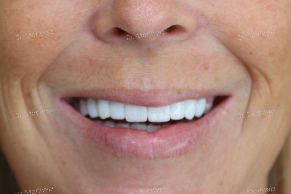 drmotiwaladcic's tweet photo. Journey to #FullMouthFixedRehabilitation from #snapondentures, which caused the patient #discomfort and #pain in her #teeth and #gums. #Hyderabad #India #Australia #usa #london #austria 
#cosmeticdentistry #dentalimplants #zirconiacrowns #fixedteeth https://t.co/0CI5vXmQl9