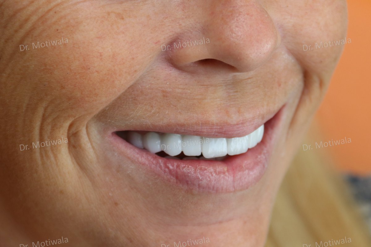 drmotiwaladcic's tweet photo. Journey to #FullMouthFixedRehabilitation from #snapondentures, which caused the patient #discomfort and #pain in her #teeth and #gums. #Hyderabad #India #Australia #usa #london #austria 
#cosmeticdentistry #dentalimplants #zirconiacrowns #fixedteeth https://t.co/0CI5vXmQl9
