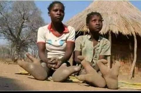 The Vandoma people of Zimbabwe 🇿🇼 have only two toes. The Vadoma people also known as Bantwana tribe means 'descendants' are a tribe living in northern Zimbabwe, generally in Sipolilo and Urungwe districts of Zambezi river valley. Their main language is Dema language.