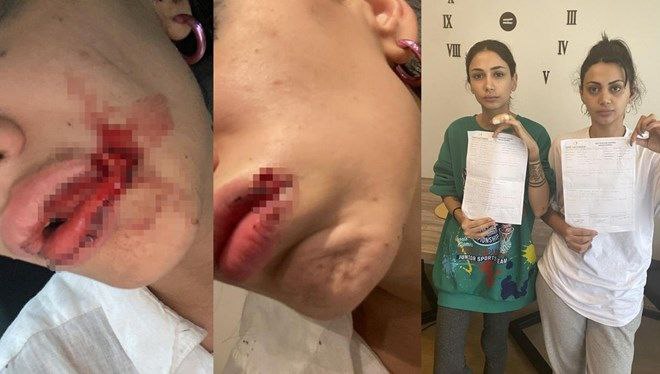 İstanbul Kağıthane'de iki kız kardeş, kimliği belirsiz bir kişinin önce sözlü tacizine maruz kaldı ardından saldırıya uğradı. Kardeşlerden birinin dudağına 20 dikiş atıldı. Saldırganın yakalanması için çalışma başlatıldı.