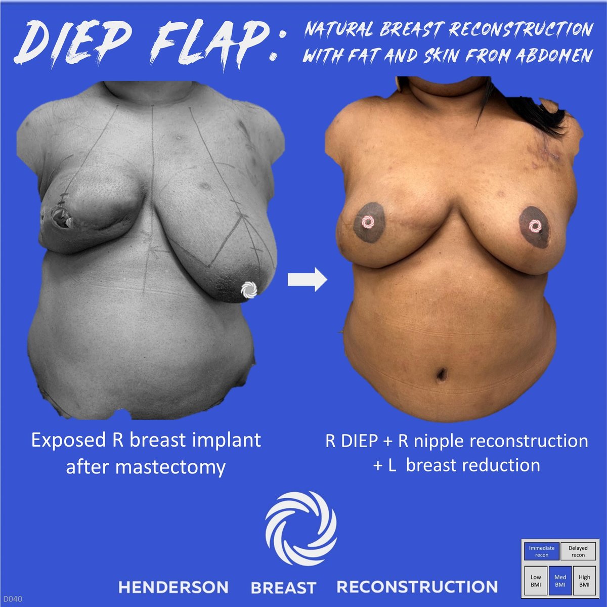 Peter Henderson MD (@hendersonbreast) / Posts / X, image size:1200x1200