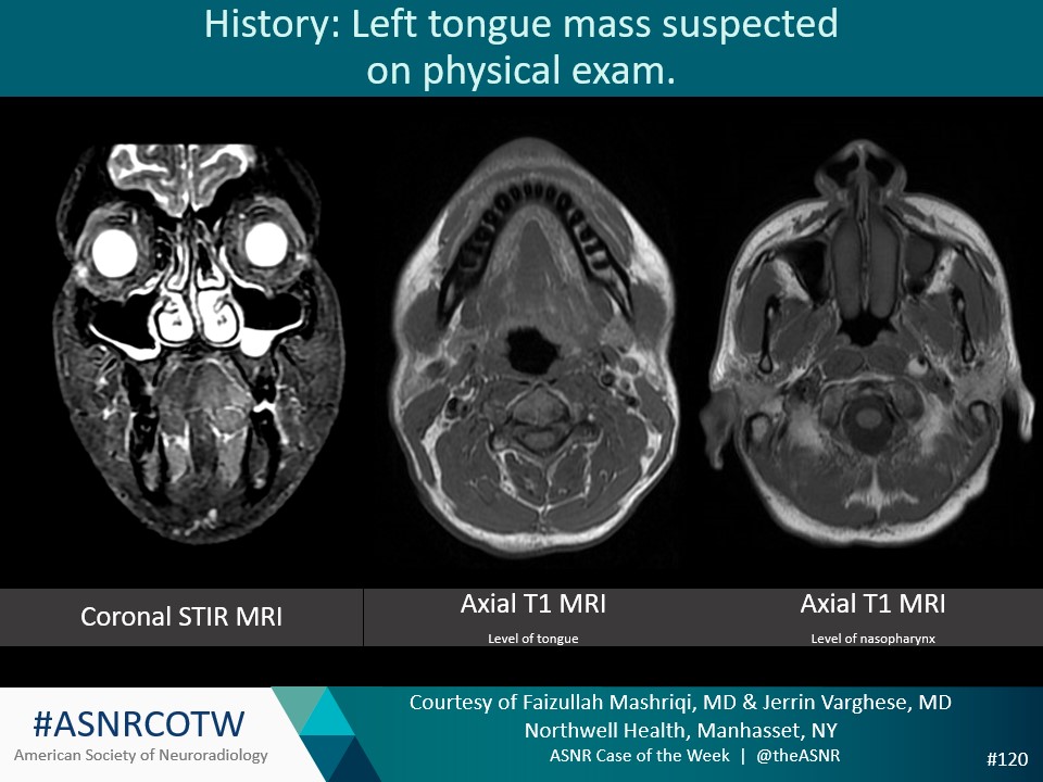 ASNR COTW #120 Hx: left tongue mass suspected on physical exam. NO SPOILERS! Give hints in the form of GIF or answer attached poll. Answer in 24 hrs #Neuro #Neurorad #Erad #radres #FOAMed #FOAMrad #medtwitter #ASNRCOTW