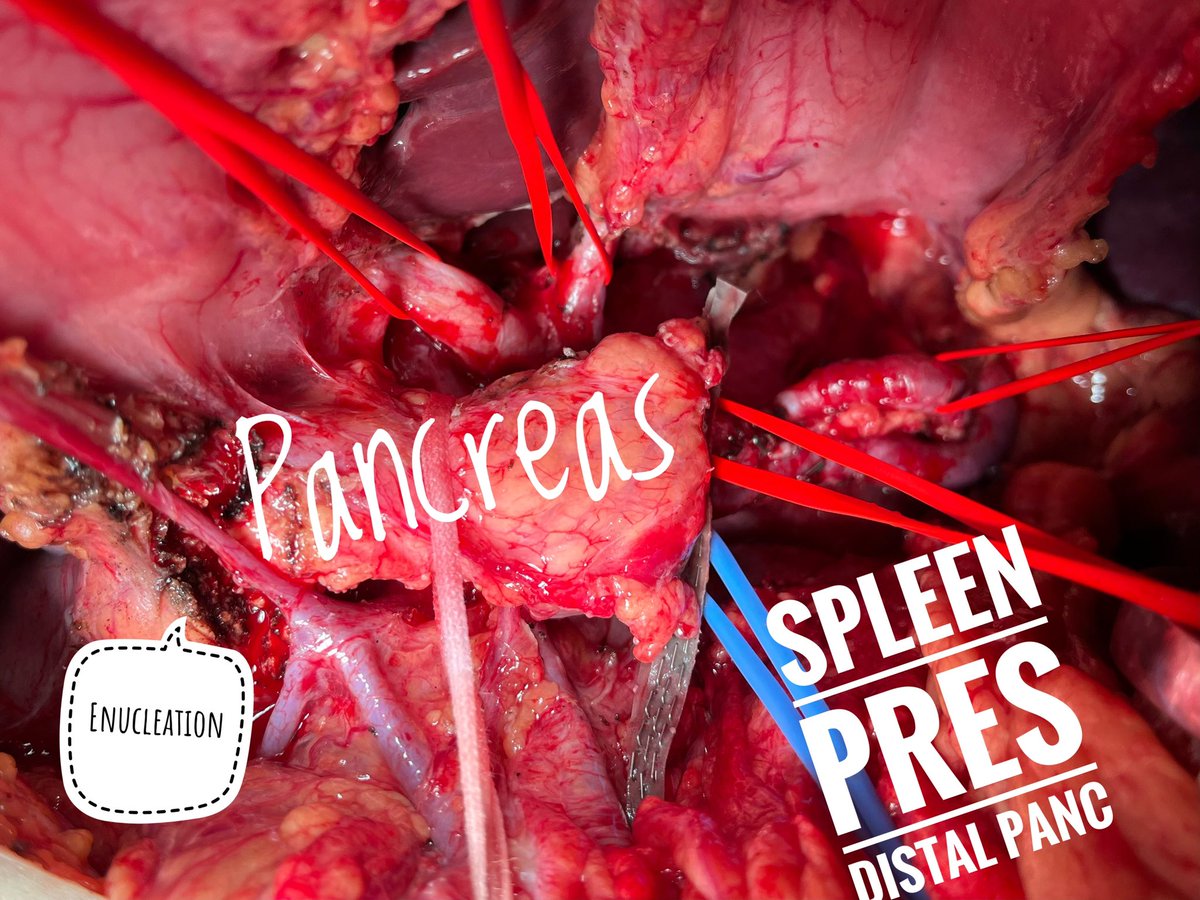 Gio_Marchegiani's tweet photo. 🦓 Surgery for multiple insulinoma of the pancreas in a 20 y/o patient with MEN 

☢️ 1 lesion in the head, 2 body tail 

🦯 MPD stent placed endoscopically before surgery to secure duct 

🧀 Deep enucleation + spleen preserving distal pancreatectomy 

👉https://t.co/45DfF0A5Et https://t.co/0ey2cmwLJh