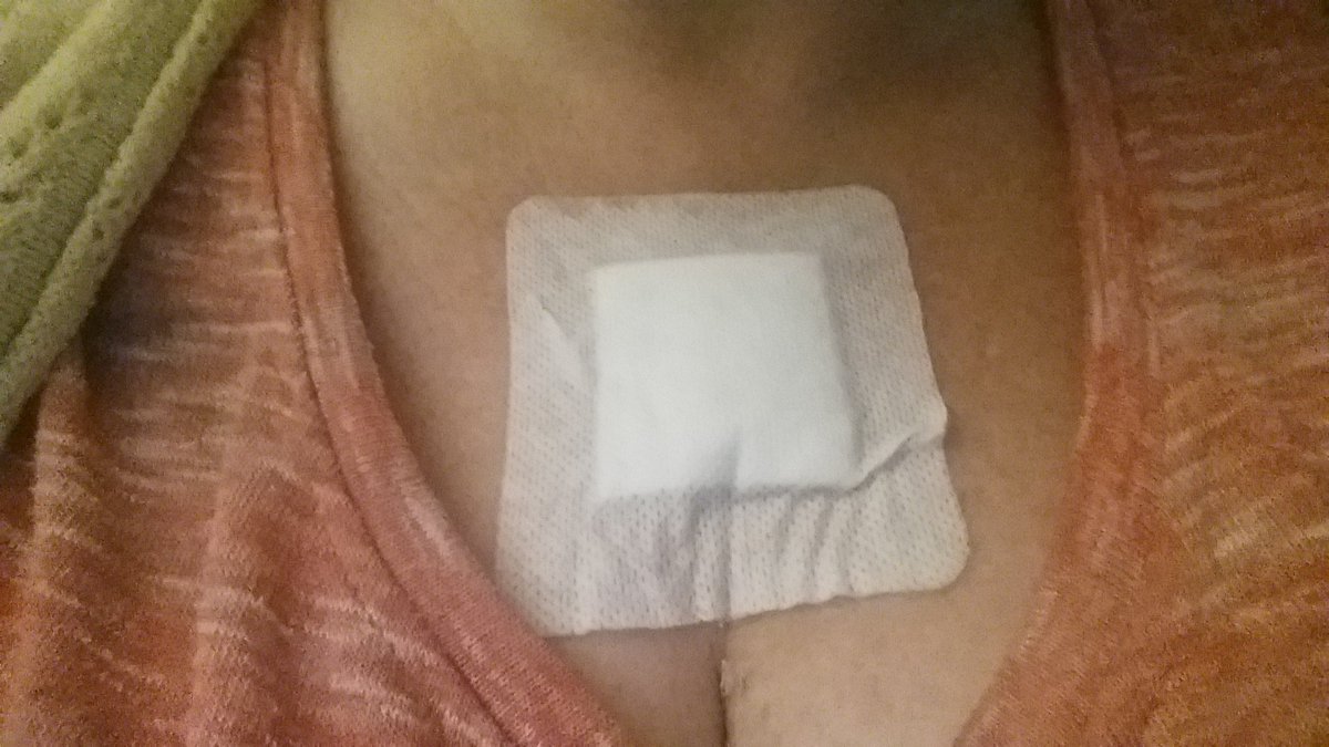 Djwise79's tweet photo. So I recently went through a skincancer scare , I had opertain on Monday. Please check ur self and use #factor #suncream. Beat it before it beats us. #biopsy #skincancer #life can change in a second https://t.co/6jvJqXR80a