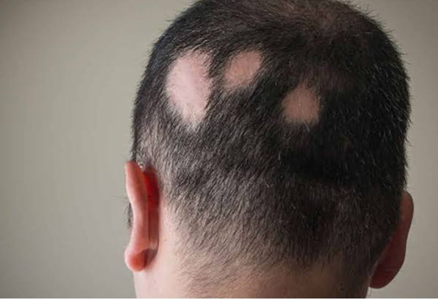 Hcmtt's tweet photo. #Üzüntü, #sıkıntı ve #Stres #Saçkıran (#Alopesi) sorunu oluşturabiliyor.
Bunun için Saçkıran olan bölgeye sabah-öğle-akşam üç kere oksijenli su (%3 lük hidrojen peroksit) sürün.
Bir kaç gün içerisinde düzelecektir.
Ayrıca bir sarımsağı ikiye bölün saçkıran olan bölgeye sürün. https://t.co/5rNy1biNVr