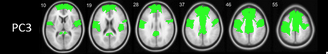 Our former PHD student Sygrid van der Zee has a new paper out from our lab showing that cholinergic integrity of a centrocingulate neural network is a robust predictor of cognitive impairment in people with PD. Check it out: frontiersin.org/articles/10.33…