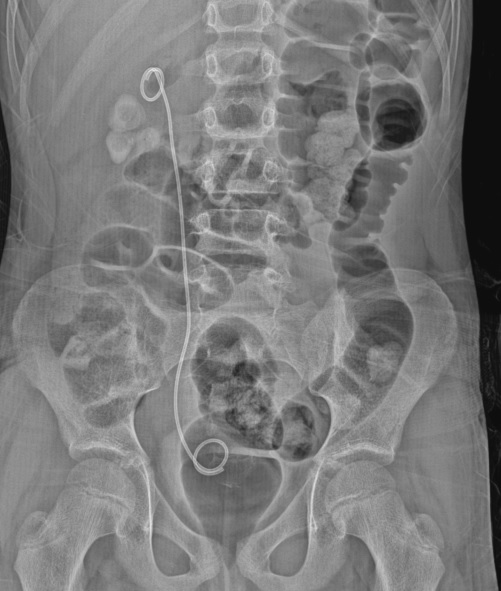 d_dorucu's tweet photo. Case 2: 11 yo pt with right renal stone https://t.co/sLHBNaMu5R