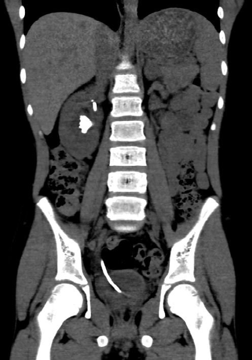 d_dorucu's tweet photo. Case 2: 11 yo pt with right renal stone https://t.co/sLHBNaMu5R